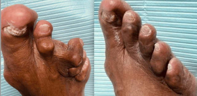 Best Foot Doctor NY- Before and after MIS foot surgery
