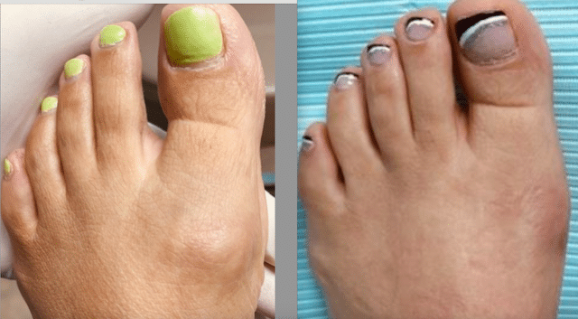 Best Foot  Doctor NY- before and after MIS bunion surgery