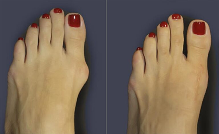Before and after bunion surgery: a prominent bunion on the left, a straight foot on the right