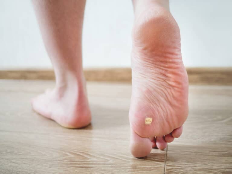Sole of a raised foot showing a small plantar wart while walking on a wooden floor
