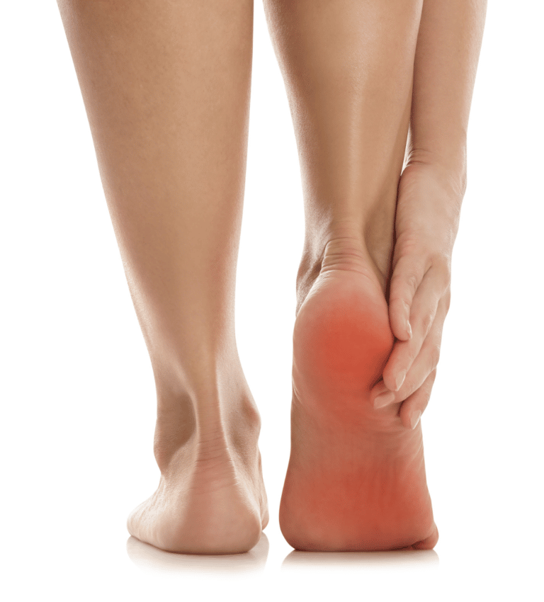 Two bare feet from behind, one heel and sole glowing red with pain