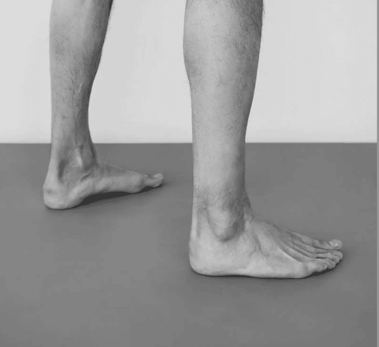 Black and white photo of a person standing barefoot showing a collapsed arch