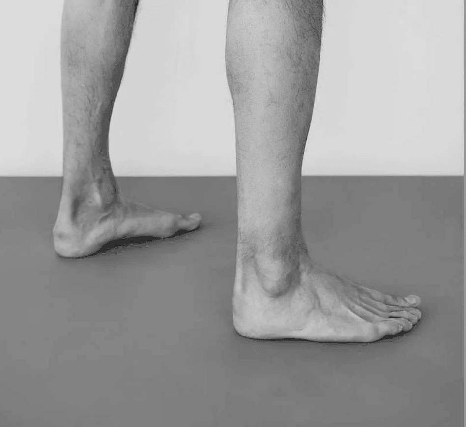 flat-feet-surgery-faqs-best-foot-doctor-ny