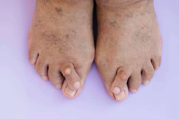 Is There Any Way to Treat a Hammertoe Without Surgery? - Best Foot