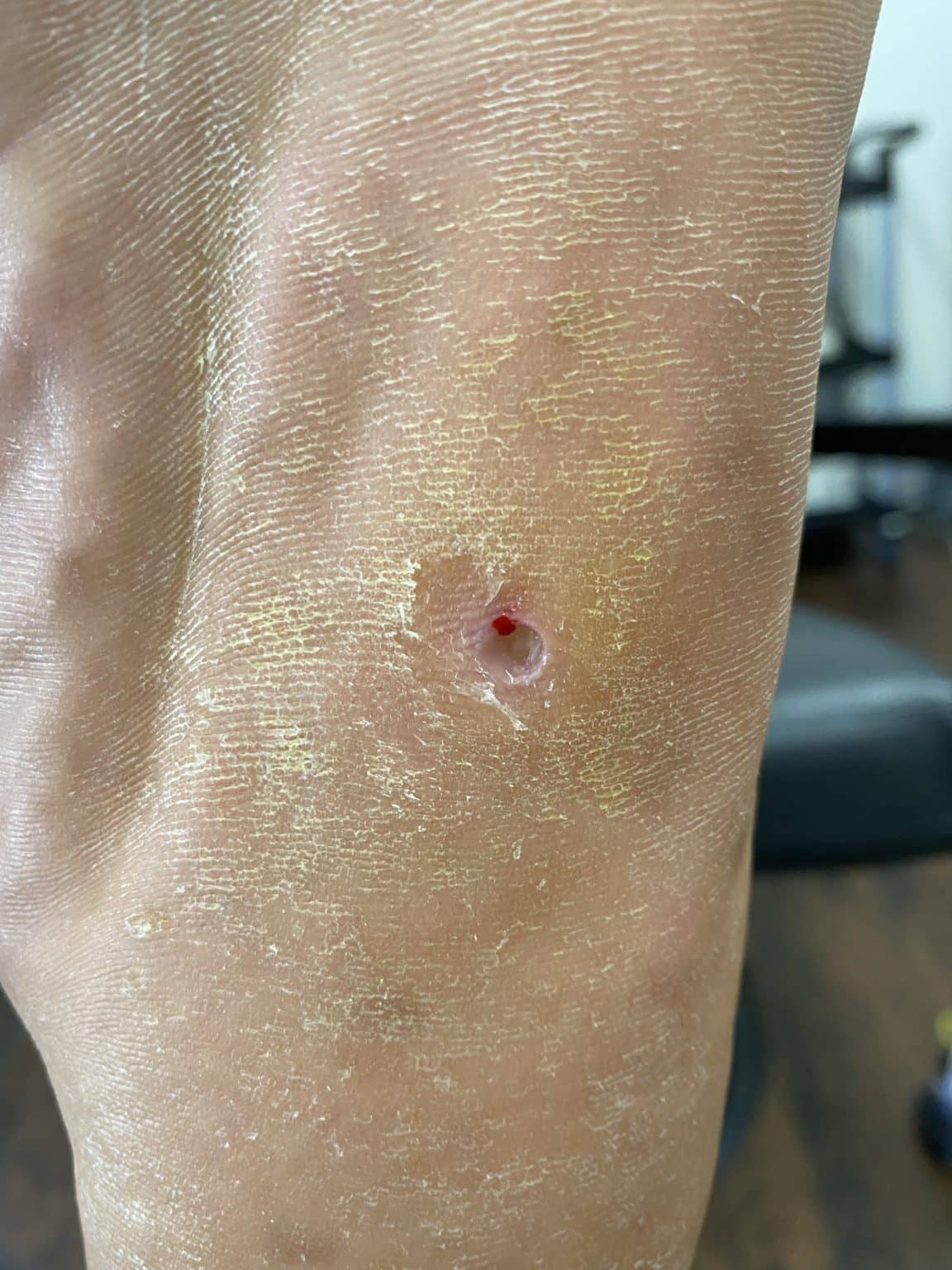 Hammertoe and Corns Diagnosis and Treatment in Brooklyn NYC