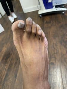 Hammertoe with bent big toe