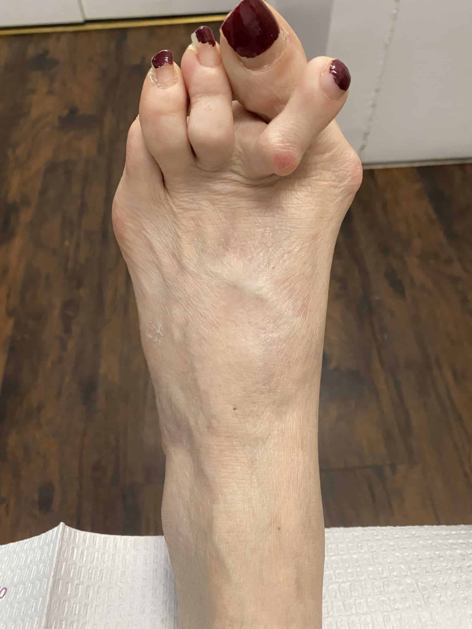 Hammertoe and Corns Diagnosis and Treatment in Brooklyn NYC