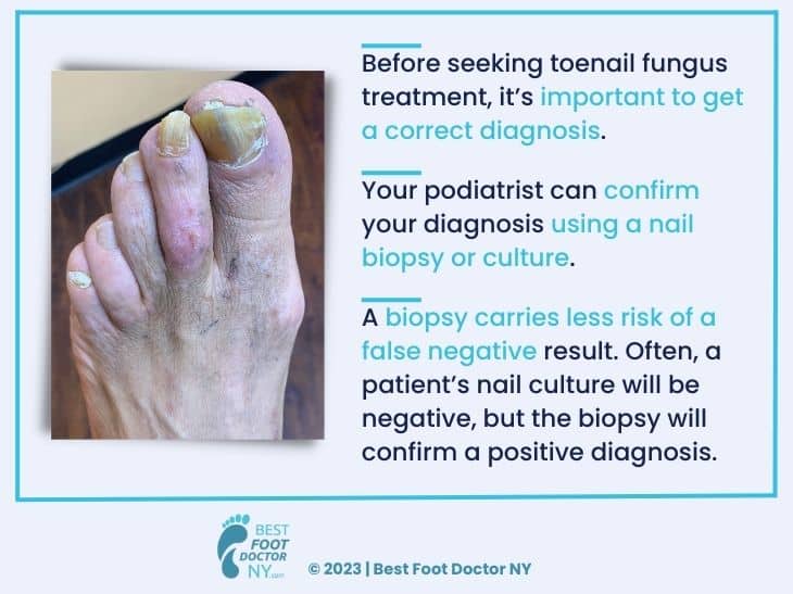 Callout 3: foot with toenail fungus- 3 facts about toenail fungus diagnosis