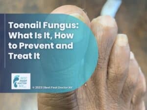 Featured: close-up of foot with toenail fungus- Toenail Fungus?
