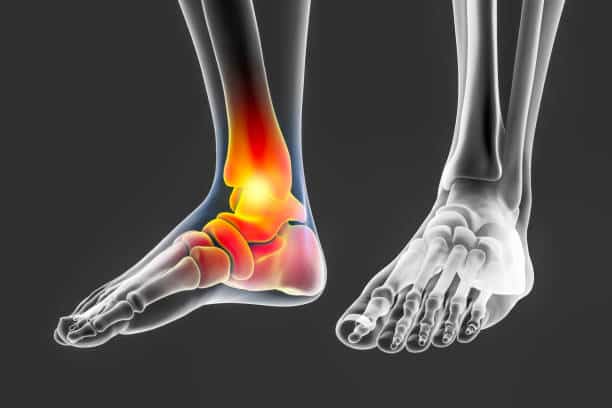 Brooklyn Podiatrist: How To Prevent Achilles Tendonitis Treatment