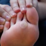 Sole of a foot held in both hands showing a round thickened lesion on the ball of the foot