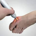 Class 4 MLS laser therapy being applied to the big toe joint of a patient's foot