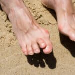Bare feet on sand showing hammertoe deformity, with the middle toes bent downward