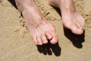 Bare feet on sand showing hammertoe deformity, with the middle toes bent downward